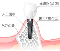 インプラントとは